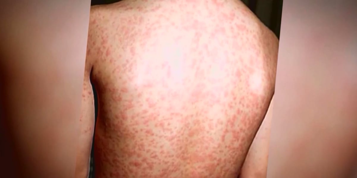 Another measles case confirmed in Missouri